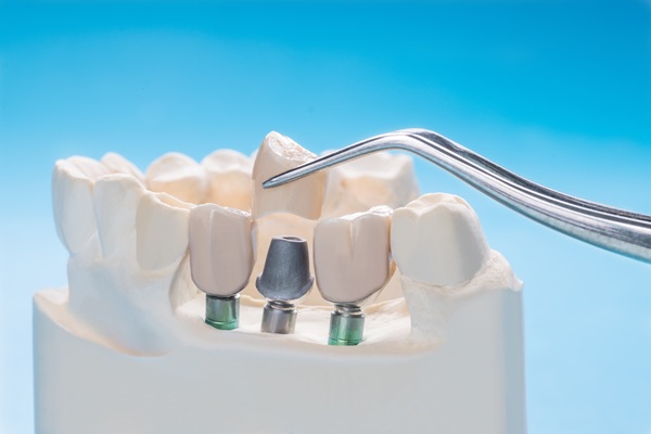 Are Dental Implants Safe?