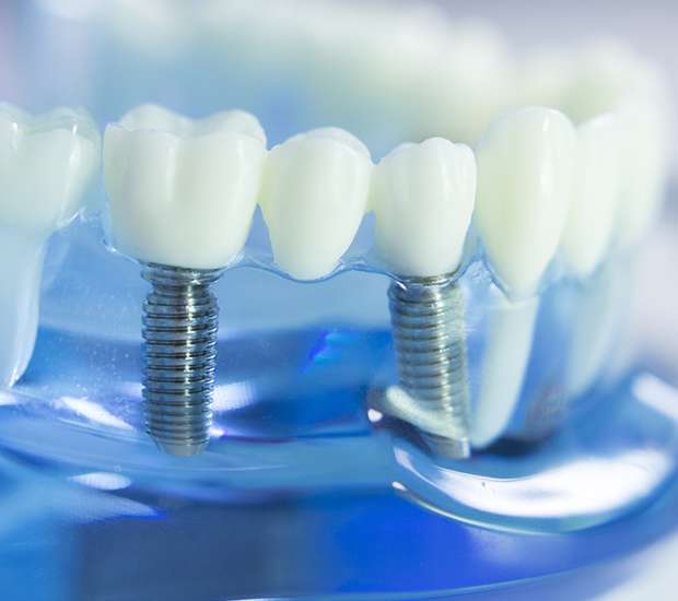 Knoxville Dental Implants