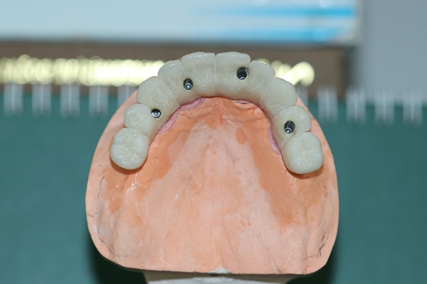The Safety And Efficacy Of Implant Supported Dentures