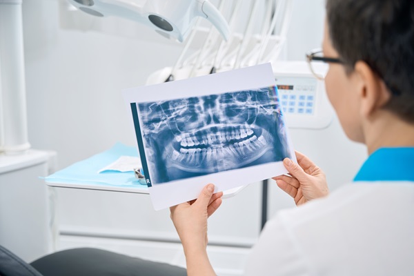 Step By Step Guide To Root Canal Procedure