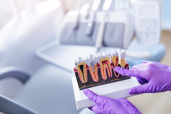 Common Concerns After Getting A Root Canal